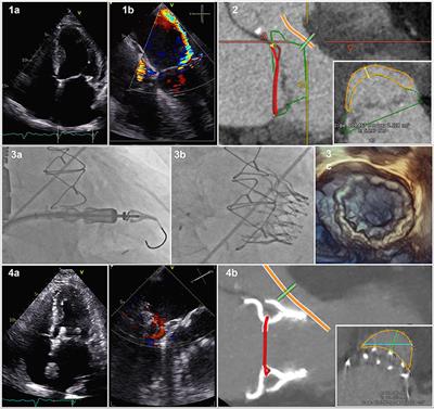 Cardiovalve in mitral valve position—Additional solution for valve replacement